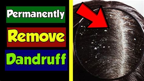 How To Cure Dandruff Permanently Naturally At Home Dandruff Treatment