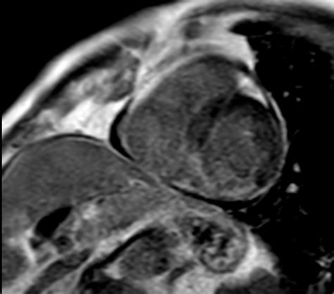 Cardiac Infarction With Fat Free Mdixon Imaging Philips Mr Body Map