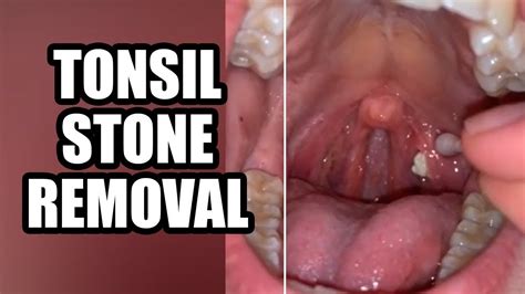 Tonsil Stone Facts And Removal Complication Youtube