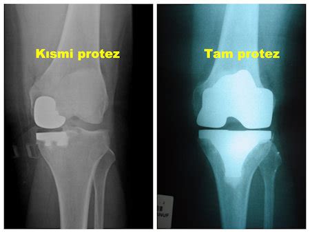 KISMİ DİZ PROTEZİ Çankaya Ortopedi