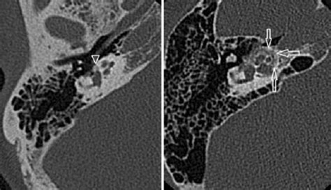 Prognosis Otosklerosis - Alomedika