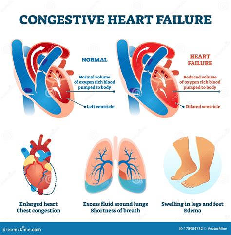 Congestive Heart Failure Vector Illustration. Labeled Medical Compare