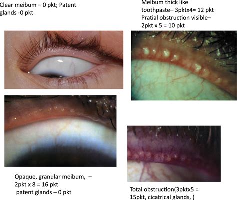 Meibomian Gland Dysfunction And Blepharitis Common And Still Unsolved