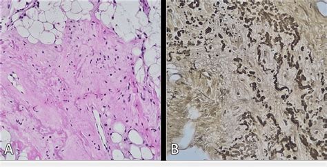 Histopathological images in the H&E stain (A) and immunohistochemistry ...