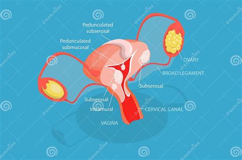 3d Isometric Flat Vector Conceptual Illustration Of Types Of Uterine