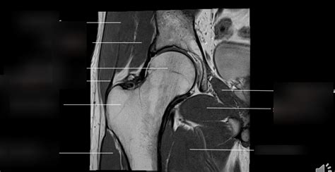 Diagram of MRI of hip | Quizlet