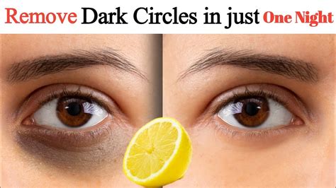 Remove Dark Circles काले घेरों को तेजी से दूर करें Dark Circle