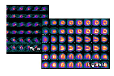 Cardiac PET CT Molecular Imaging Services MIS