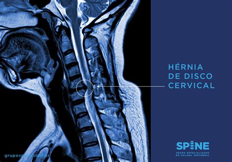 Grupo Spine H Rnia De Disco Cervical