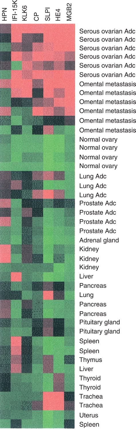 Gene Expression Profile Of Putative Biomarker MGB2 In Ovarian Serous