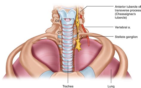 Stellate Ganglion Blocks Portland Pain Solutions