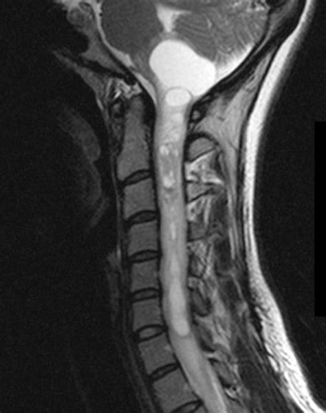 Intramedullary Masses Of The Spinal Cord Radiologic Pathologic