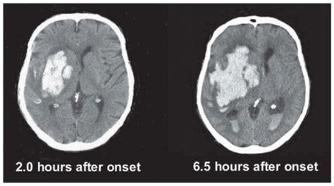 Intracerebral Hemorrhage Neupsy Key