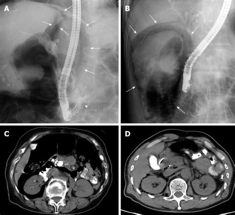 Figure 2 From Immediate Detection Of Endoscopic Retrograde Cholangiopancreatography Related