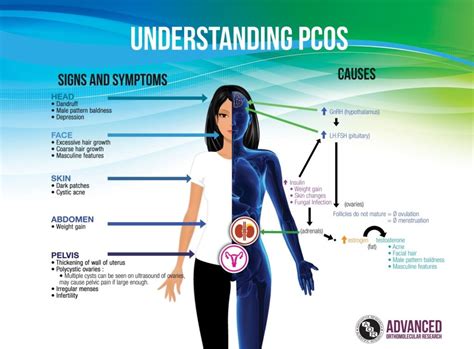 Know The Symptoms Of Polycystic Ovarian Syndrome