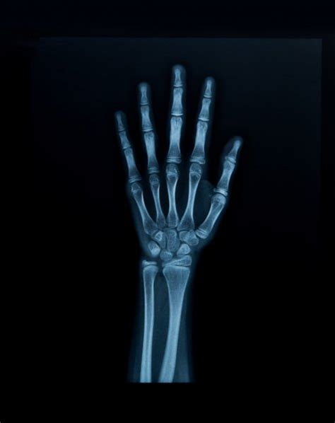 X Rays Of Hands