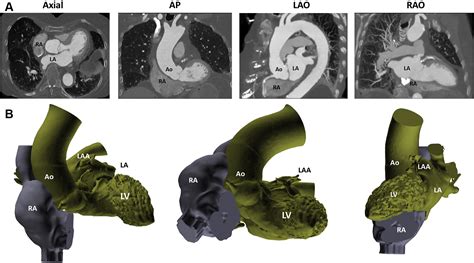 Anatomic Approach To Transseptal Puncture For Structural Heart