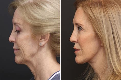 Facelift Before And After Photos Nicole Schrader Md Facs