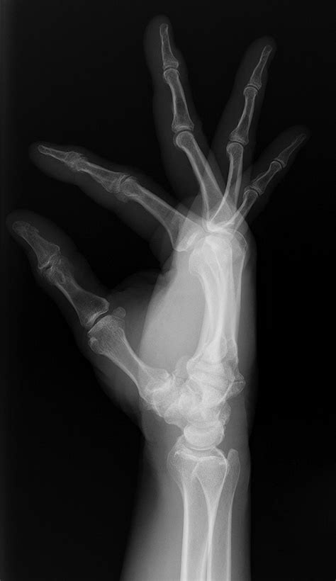 Attrition Or Rupture Of Digital Extensor Tendons Due To Carpal Boss