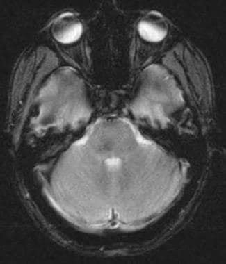 Capillary Telangiectasia Brain Imaging Practice Essentials Magnetic