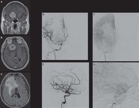 14 Diagnostic Evaluation And Embolization Of Meningiomas Neupsy Key