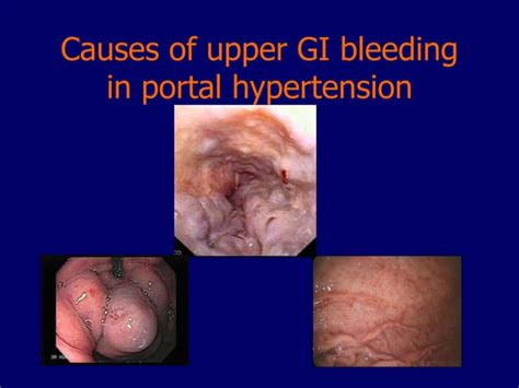 Management Of Acute Upper GI Hemorrhage PPT