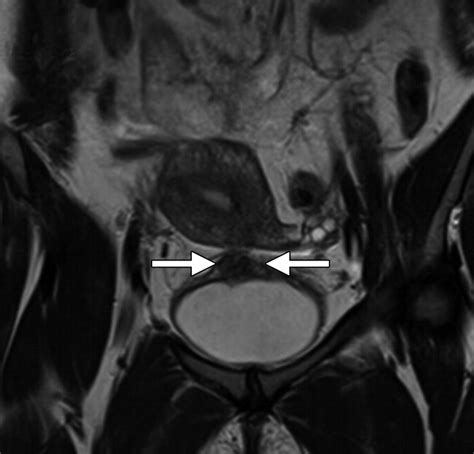 Deep Pelvic Endometriosis A Multidisciplinary Approach 10