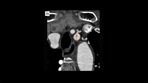 Complex Coronary Artery Fistula Siemens Healthineers USA