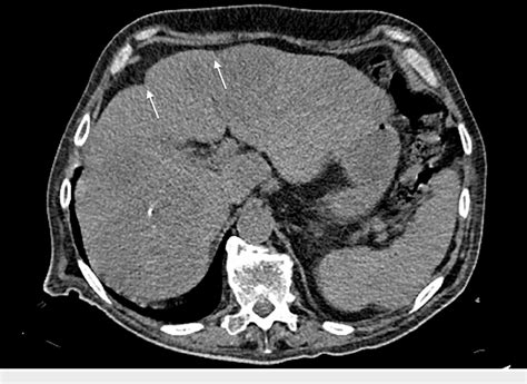 Figure 1 From A Rare Case Of Perforated Caecal Cancer Disguised As A