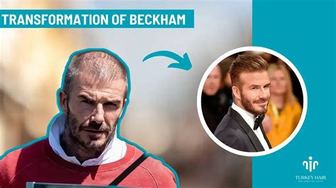 Unbelievably Story About David Beckham Hair Transplant 2023 | Turkey ...