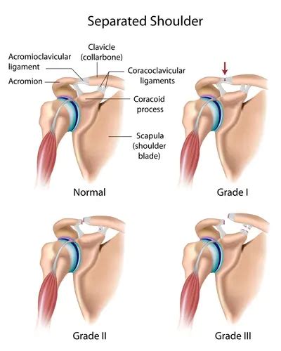 Can AC Joint Separation be Treated Without Surgery? | Fort Collins Back ...