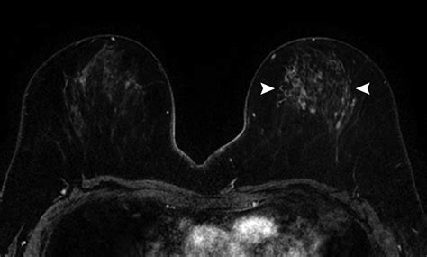 Preoperative Breast Mri Can Reduce The Rate Of Tumor Positive Resection