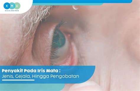 Penyakit Pada Iris Mata : Jenis, Gejala, Hingga Pengobatan