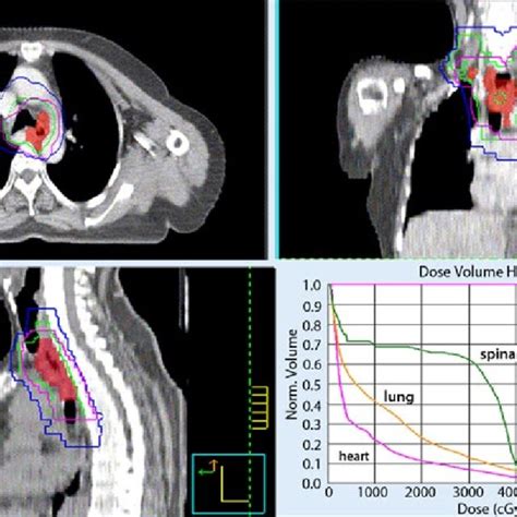 8 Isodose Curves Of A Representative Intensity Modulated Radiotherapy Download Scientific