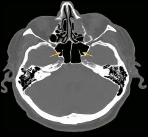 Figure 1 From Challenges Of Endoscopic Approach In Sphenoid Sinus Surgery For Beginners