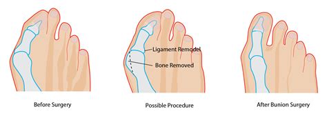 Hammertoe Correction Procedure | lawrencedrozdowski