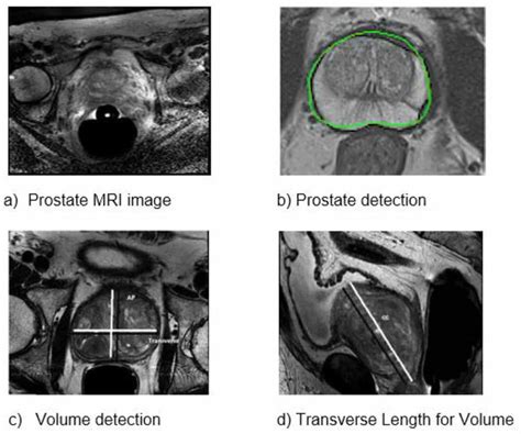 Prostate Detection And Volume Calculation Download Scientific Diagram