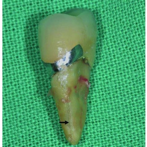 Clinical symptoms and signs of a vertical root fracture (VRF ...