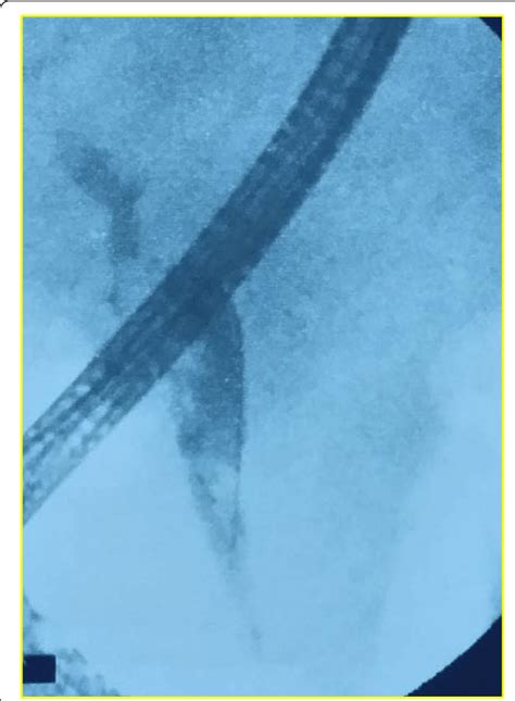 Ercp Showing Stones In The Main Bile Duct Download Scientific Diagram