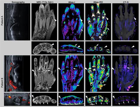 Imaging Examples In Coronal And Axial Orientation Mri T1fs Gd