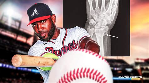 Braves: Marcell Ozuna reveals injury severity after getting hit by pitch