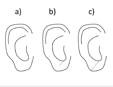 Earlobe Crease A B And C Show Representative Schema Demonstrating