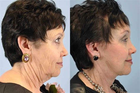 Facelift Gallery Dr Paul Vanek Mentor Plastic Surgery