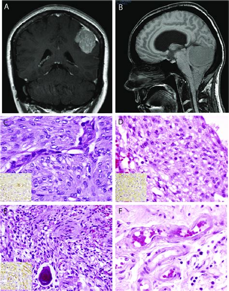 MRI Location And Histologic Appearance Of Meningiomas Occurring In