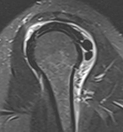 RADIODIAGNOSIS - IMAGE COLLECTION: MILWAUKEE SHOULDER