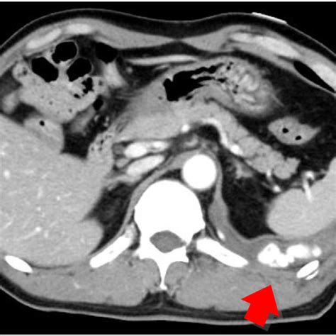 (a) Chest X-ray on admission showed no evidence of hemothorax. (b ...