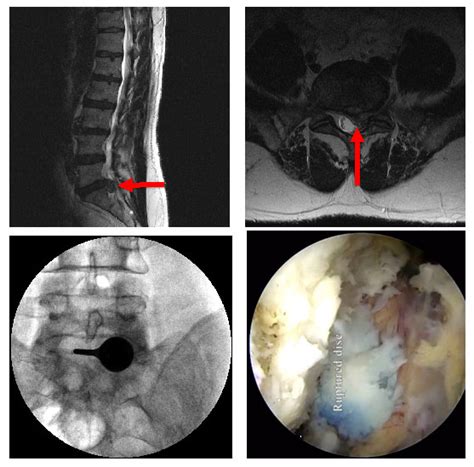 Endoscopic Lumbar Discectomy Surgery Westmead NSW Decompression