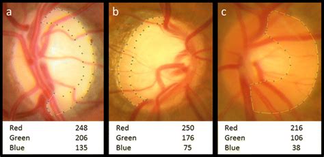 Representative Results Of Patients With Optic Nerve Atrophy And Normal