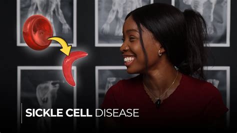 Sickle Cell Disease Understanding The Causes Symptoms And Sickle