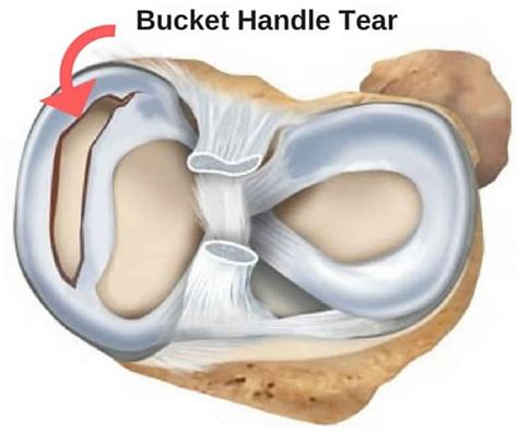 meniscus tear knee symptoms signs diagnosis treatment  recovery